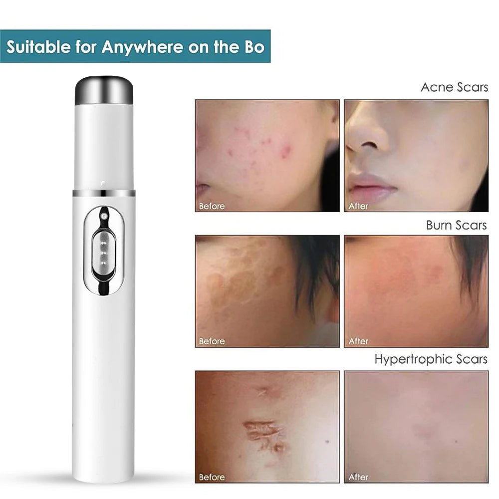 Blue Light Facial Machine Acne Wrinkle Removal Laser Pen Skin Spots Wrinkle Removal Treatment Acne Laser Pen Massage Relax
