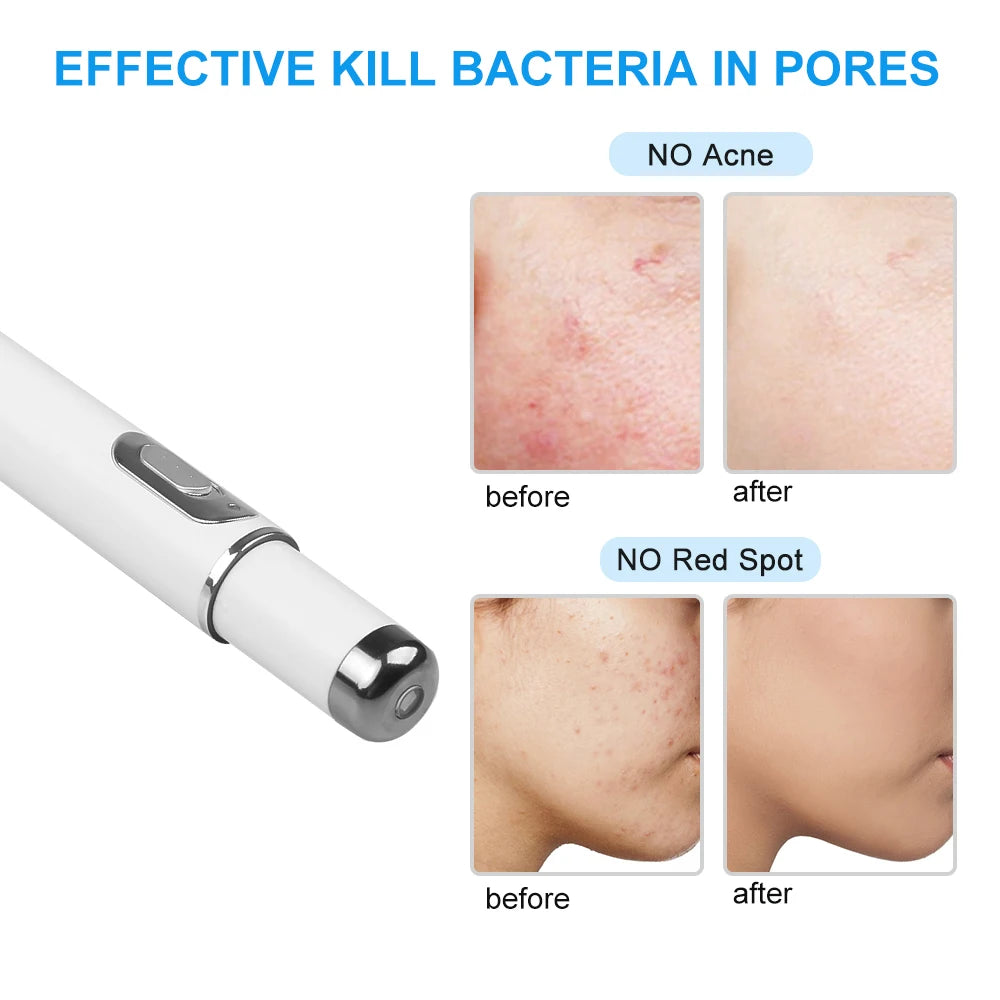 Blue Light Facial Machine Acne Wrinkle Removal Laser Pen Skin Spots Wrinkle Removal Treatment Acne Laser Pen Massage Relax