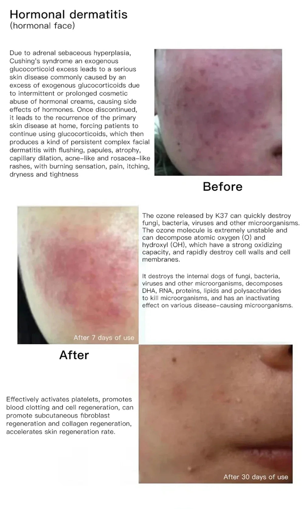 Ozone Cold Plasma Pen Blue Light Acne Removal Sensitive Skin Anti Wrinkle Deep Acne Cleaner Eliminating Acne Shrink Pores Beauty