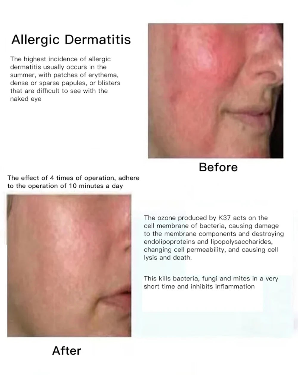 Ozone Cold Plasma Pen Blue Light Acne Removal Sensitive Skin Anti Wrinkle Deep Acne Cleaner Eliminating Acne Shrink Pores Beauty