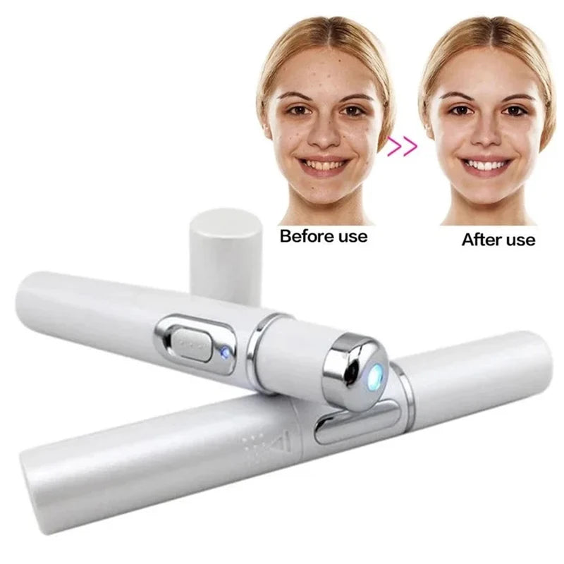 Blue Light Facial Machine Acne Wrinkle Removal Laser Pen Skin Spots Removal Anti Varicose Spider Vein Eraser Medical Treatment