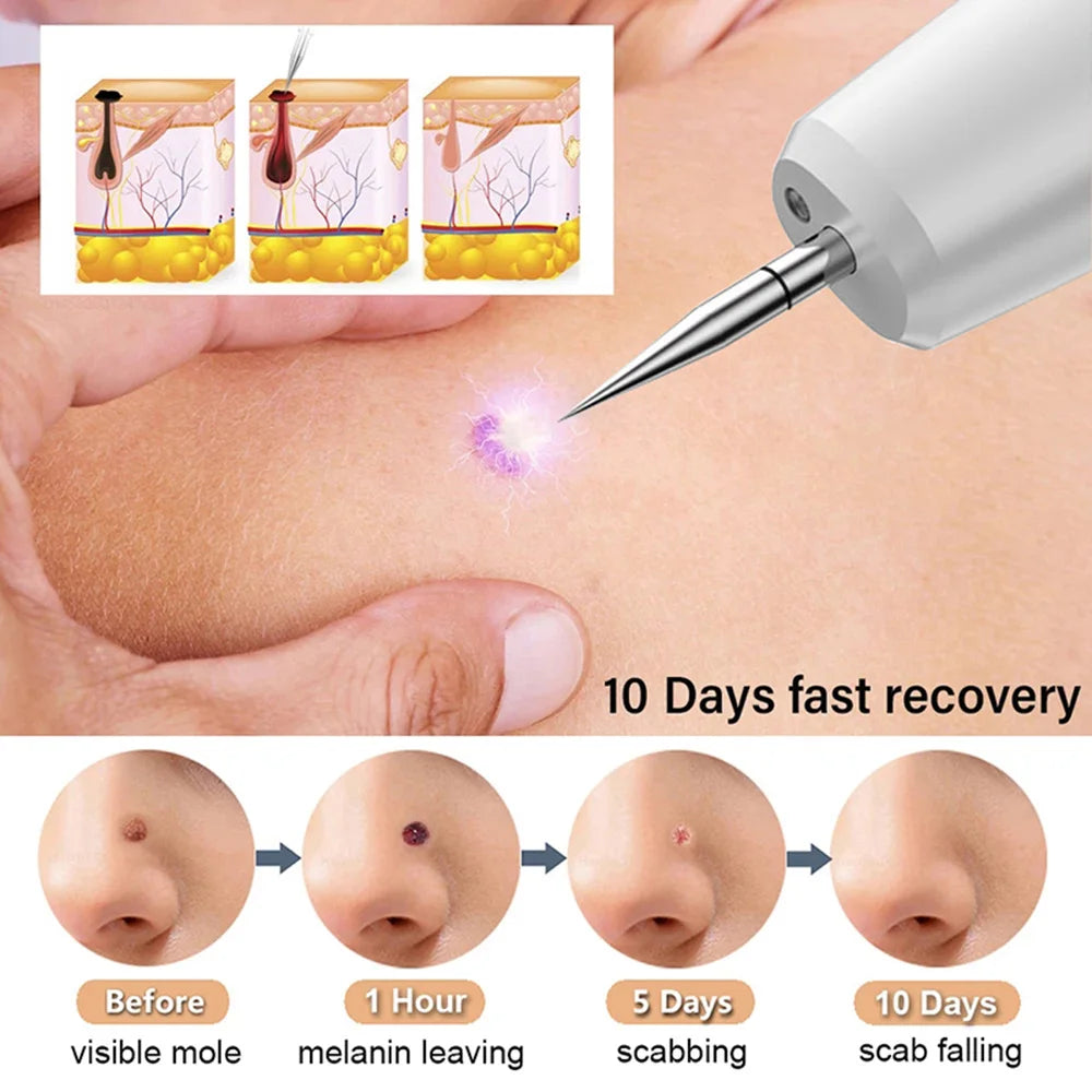 15 Level Plasma Pen Face Cleaner Freckle Black Dot Papilloma Warts Mole Pimples Removal  Blackhead Remover Beauty Skin Care Tool