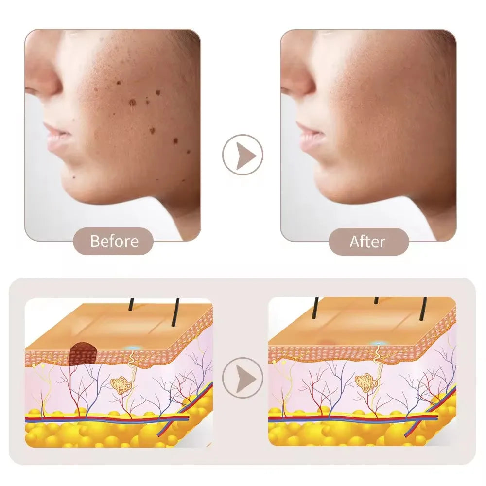 15 Level Plasma Pen Face Cleaner Freckle Black Dot Papilloma Warts Mole Pimples Removal  Blackhead Remover Beauty Skin Care Tool