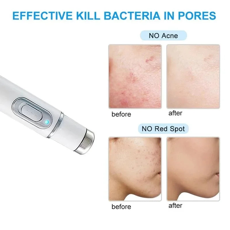 Blue Light Facial Machine Acne Wrinkle Removal Laser Pen Skin Spots Removal Anti Varicose Spider Vein Eraser Medical Treatment