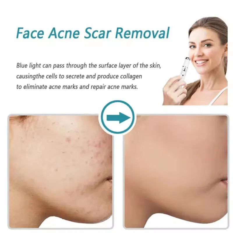 Blue Light Therapy Acne Laser Pen LED Face Light Therapy For Scar Wrinkle Removal Treatment Device Skin Care Beauty Equipment