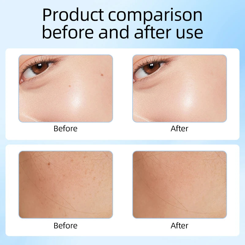 Laser Plasma Pen For Mole Dark Spot Freckle Nevus Wart Skin Tag Pimples Tattoo Removal Skin Face Care Beauty Machine Papilloma