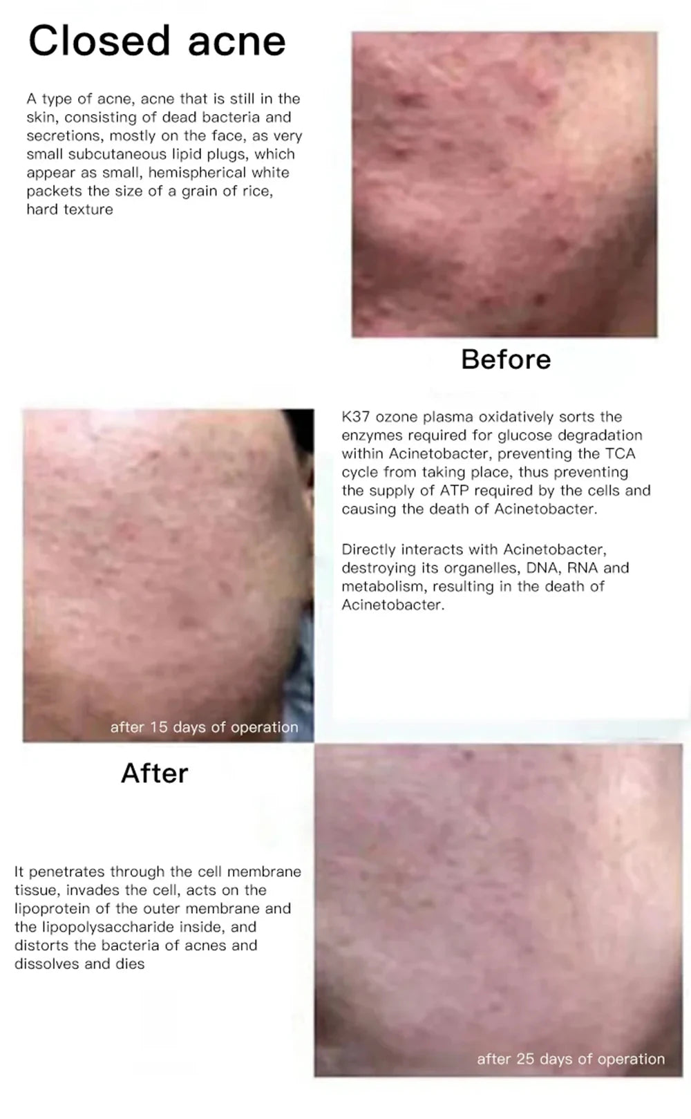 Ozone Cold Plasma Pen Blue Light Acne Removal Sensitive Skin Anti Wrinkle Deep Acne Cleaner Eliminating Acne Shrink Pores Beauty