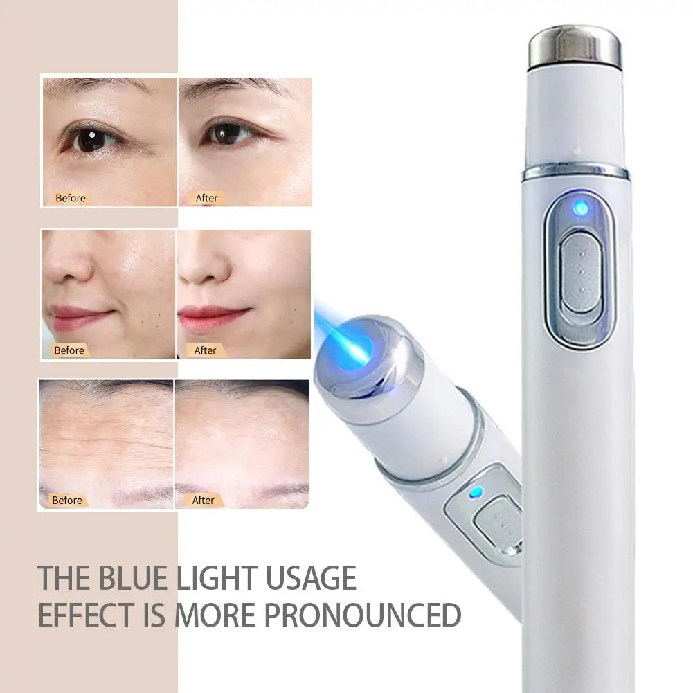 Blue Light Acne Remove Pen For Eliminating Dark Circles And Eye Bags Heating Massage For Swelling Reduction Skin Care Pen